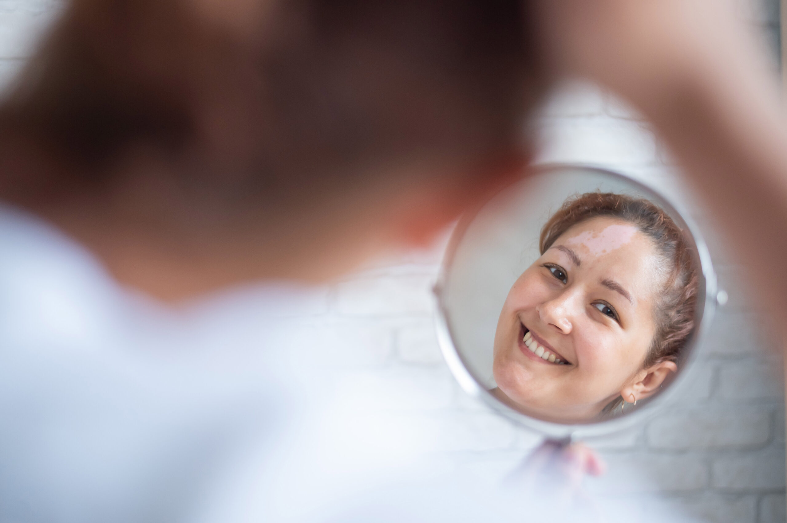 A woman with vitiligo looks in the mirror. Reflection in a table mirror a girl with a white spot on her forehead. Autoimmune disease. Lack of skin pigmentation